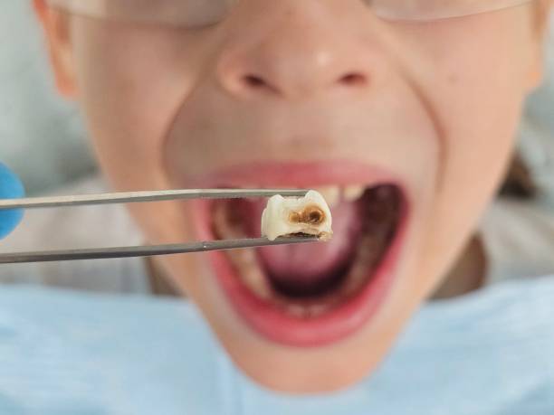 Best Emergency Wisdom Teeth Removal in Harbor Springs, MI